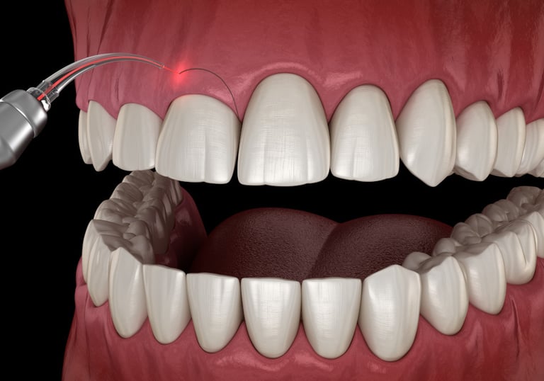 gingivectomia