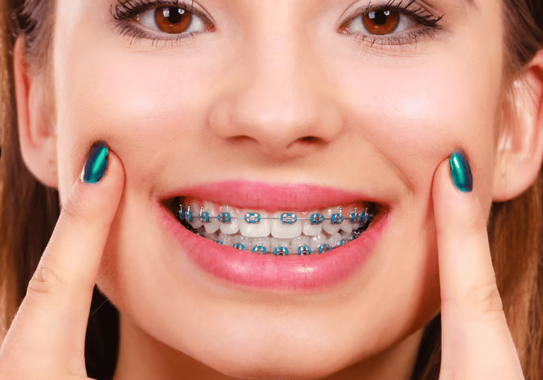 Jovem mostrando o resultado do aparelho ortodôntico colocado por dentista em Palmas especializado.