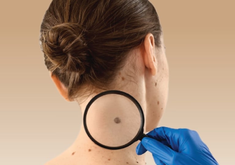 Skin Cancer Screening