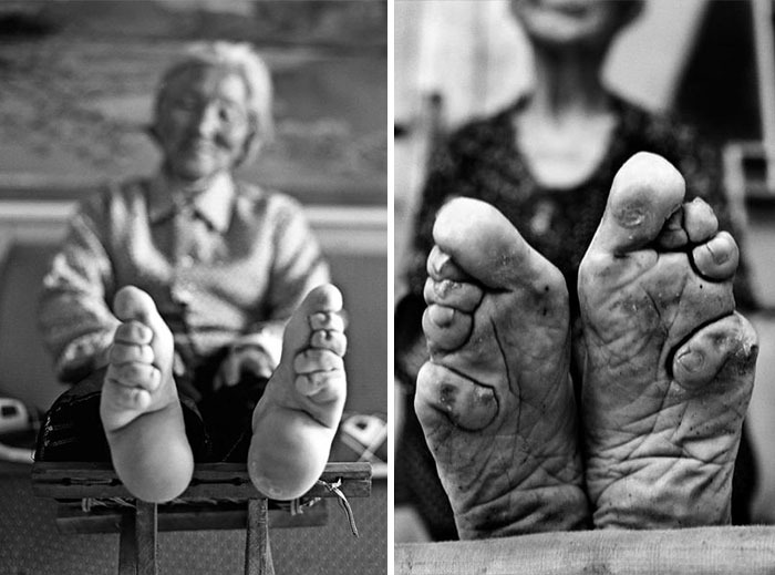 Pies Deformados por costumbres culturales y de belleza chinos