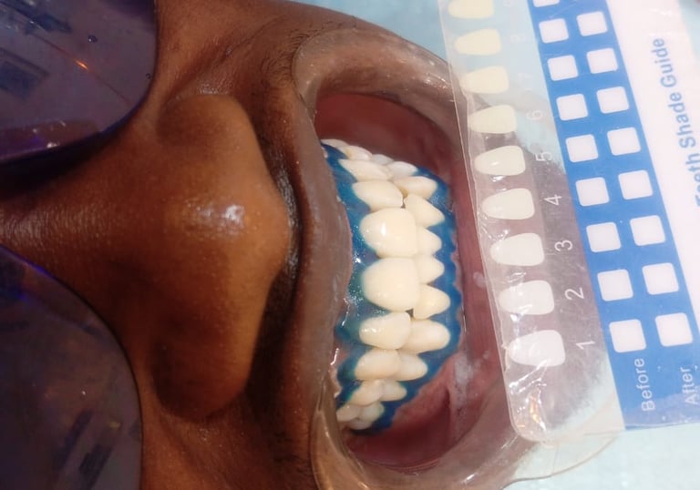 Blanchiment dentaire professionnel avec teintier pour mesurer les résultats.