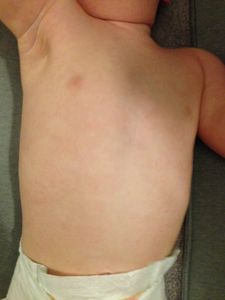 a baby in diaper pants and diaper and healed from eczema