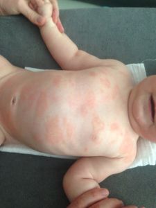 a baby with eczema is laying on a towel in a diaper