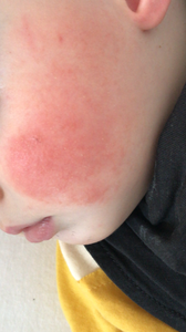 a child with a red spot on his cheek