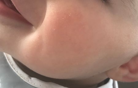 a baby with no red spot smiling and looking at the camera