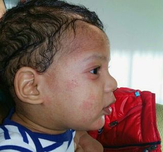 a baby boy with ecema on his face