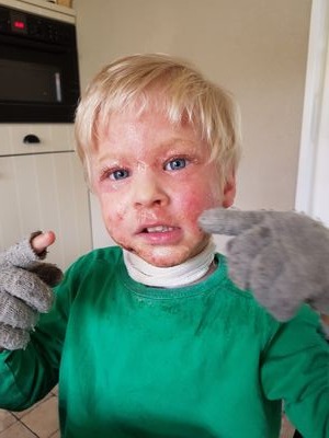 a young boy with a lot of eczema on his face