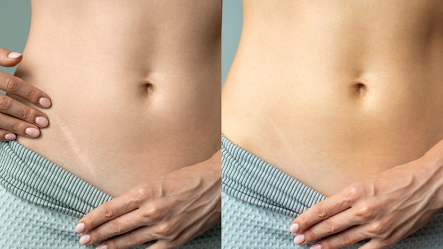 Imagen de cicatrización rapida