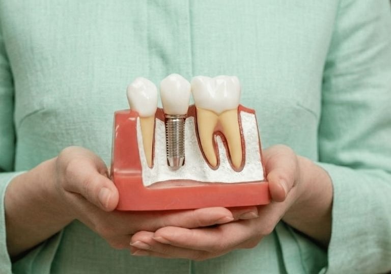 Uma profissional da área odontológica segurando um modelo de um implante dentário.