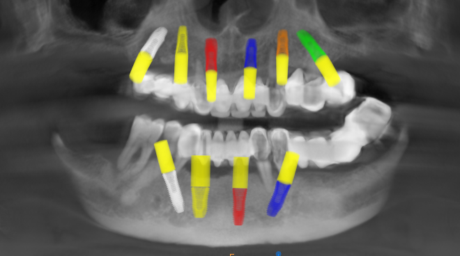 advance implantology in nagpur