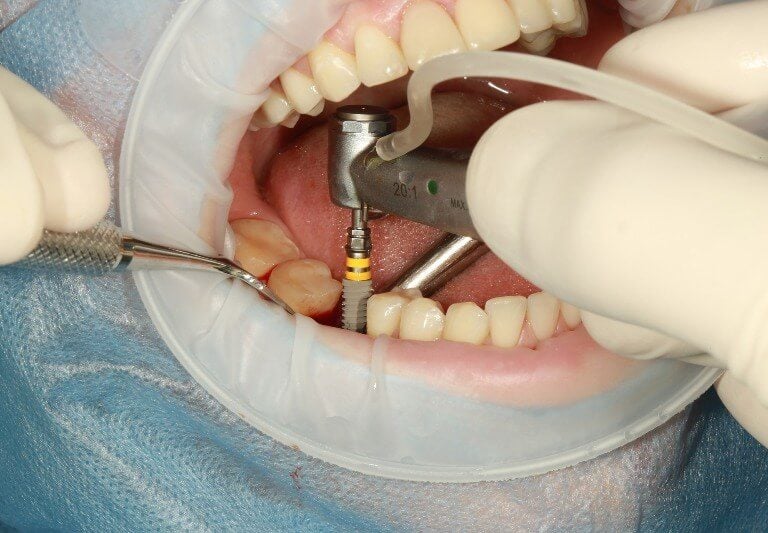 Implantes dentales en Santo Domingo