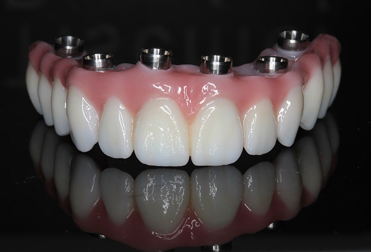 Protesis sobre implantes en Santo Domingo