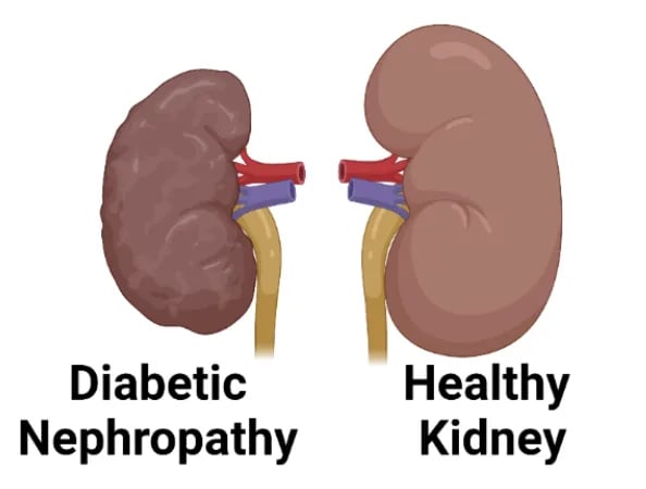 Best diabetic nephropathy treatment and care in Hyderabad