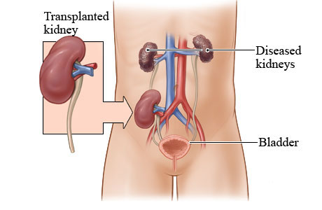 kidney transplant in jordan