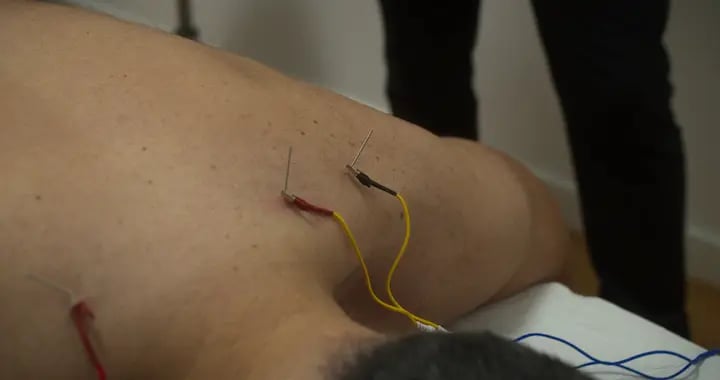 Electro Punción Fisioterapia Argoños