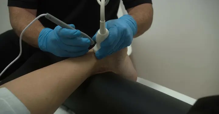 EPI en Tendón de Aquiles Fisioterapia Argoños