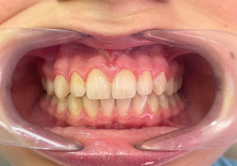 Proste zęby po leczeniu ortodontycznym