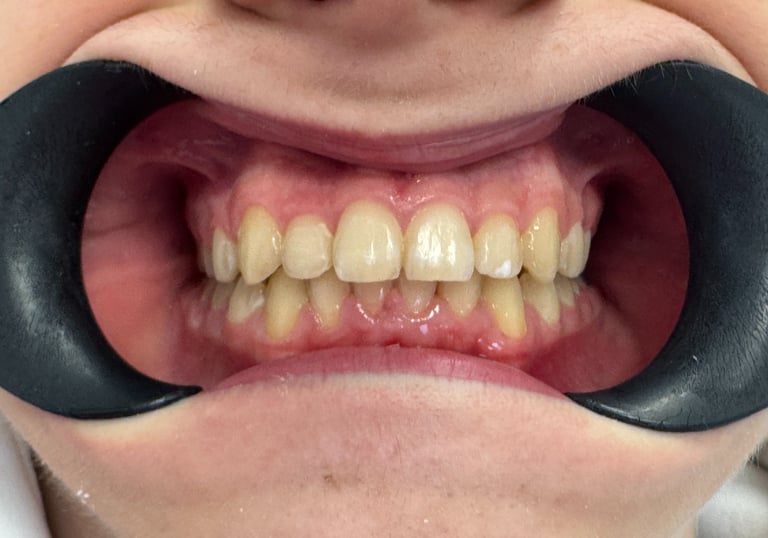 Proste zęby po leczeniu ortodontycznym