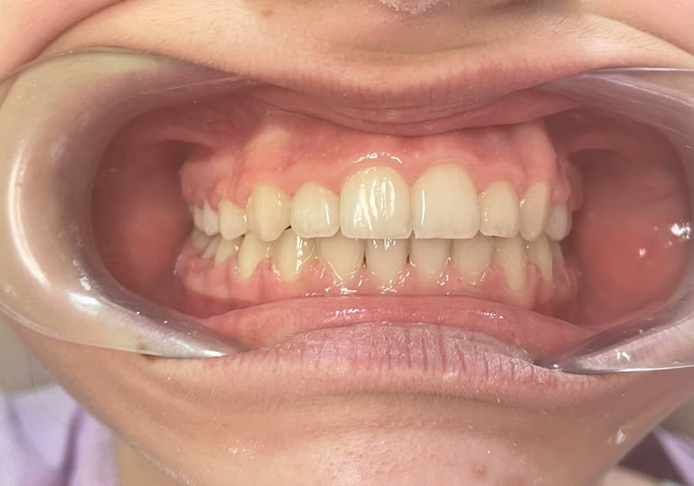 Proste zęby po leczeniu ortodontycznym