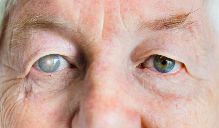 Idoso com catarata visível em um dos olhos, contrastando com o outro olho saudável
