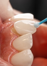 Veneers İzmir — hauchdünne Keramikschalen für ein natürliches Lächeln bei Designed Smiles