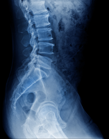 Röntgenbild av ländryggen i profil som används vid bedömning hos legitimerad kiropraktor i Malmö.