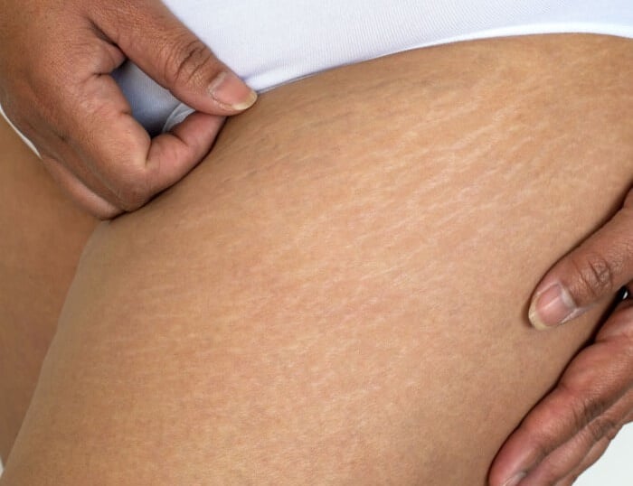 cabinet perma médical : peau d'orange, vergétures, relâchement cutané