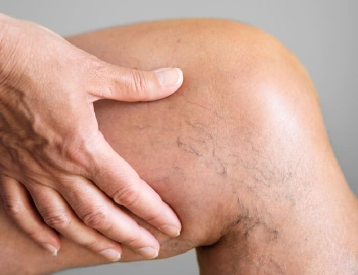 varicosité des membres