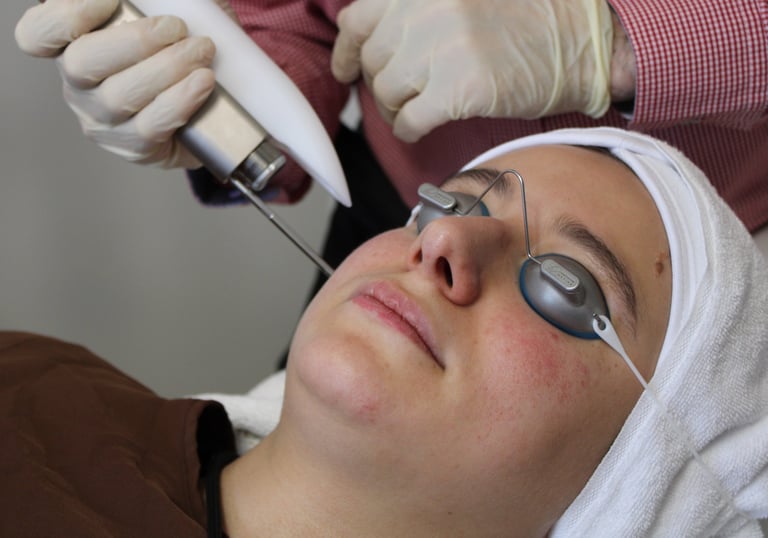cabinet perma médical : soin rosacée