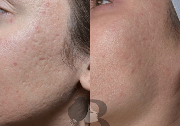 microneedling before and after