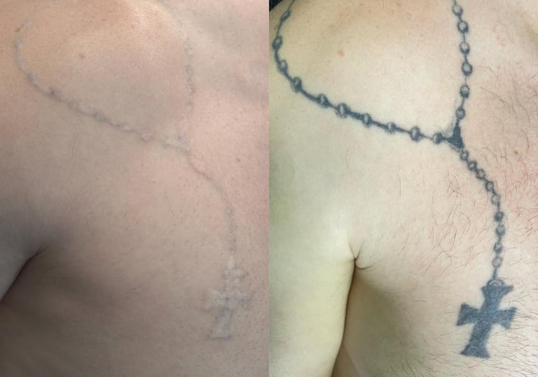 remoção de tatuagem em homens