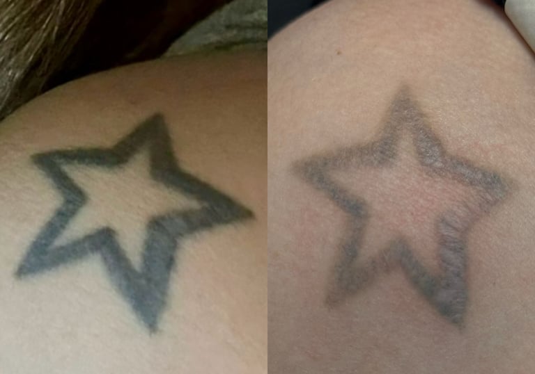 resultado após três sessões de remoção a laser 