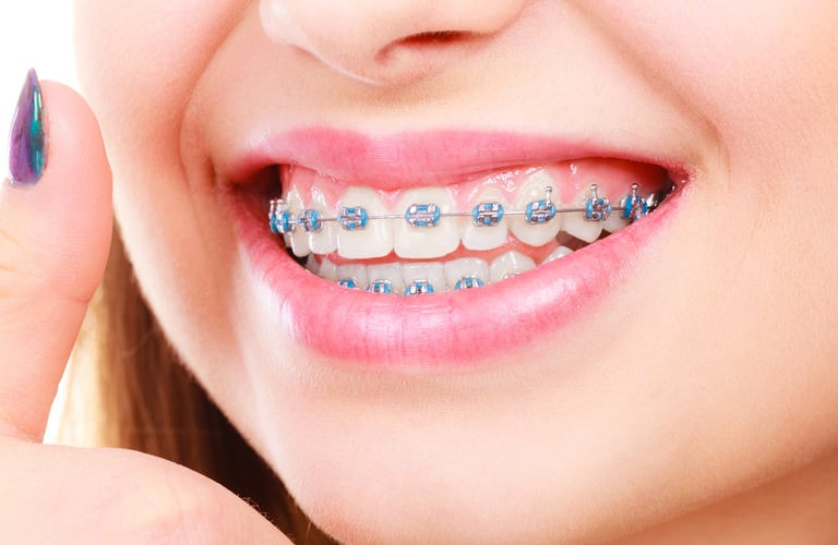 Una sonrisa que muestra brackets dentales para tratamiento de ortodoncia y dientes alineados.