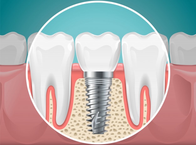 Un diagrama de un implante dental con tornillo y corona colocado en el hueso maxilar entre dientes.