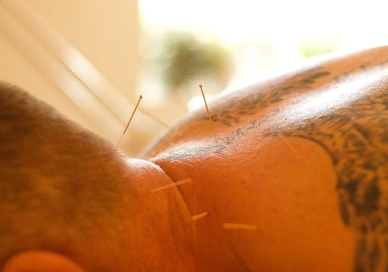 Close up of the back of a mans neck with acupuncture needles in