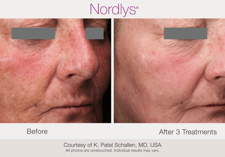 before and after acne scar treatment results at Texture & Tone Skin Studio in Hamilton