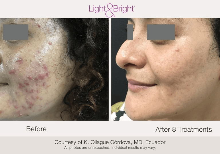 before and after acne scar improvement after treatment at Texture & Tone Skin Studio in Hamilton