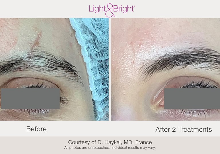 before and after acne scar and stretch mark treatment results in Hamilton