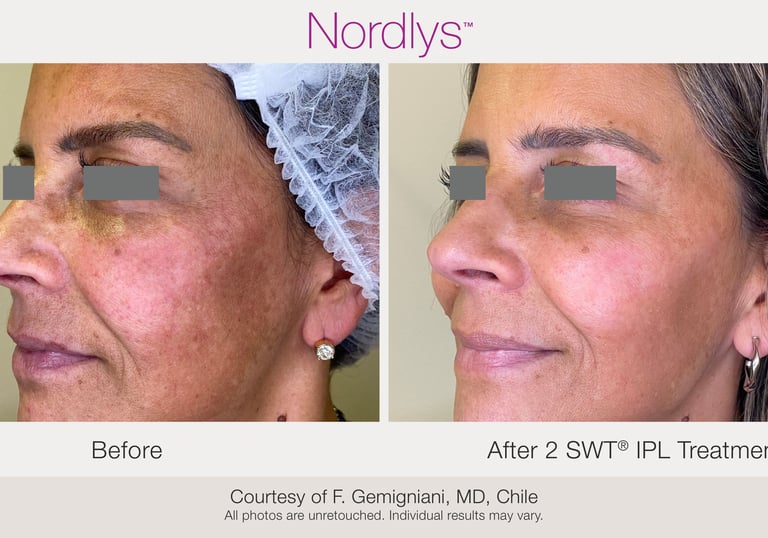 before and after rosacea and redness treatment results in Hamilton