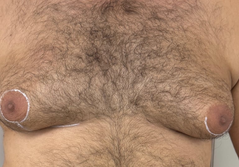 Genç erkek hasta meme büyüklüğü sadece yağ dokudan ibaret değil. Gerçek Jinekomasti