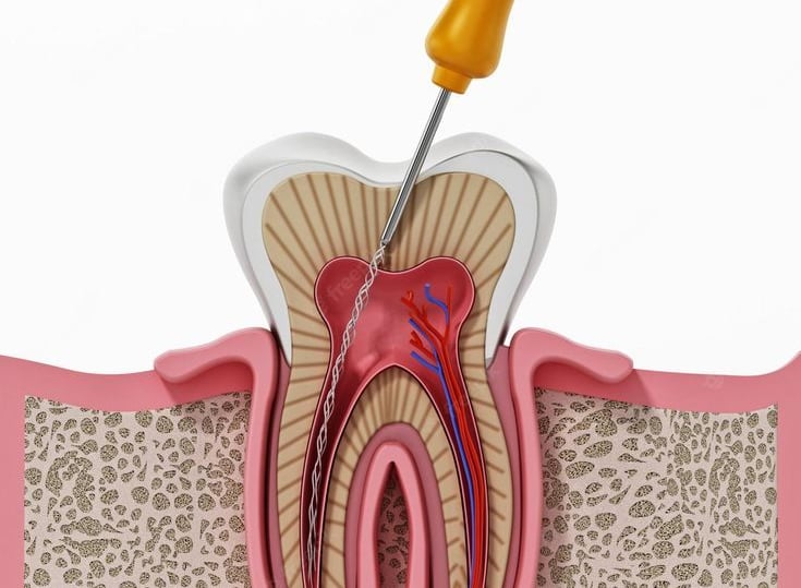 Cross-section diagram of a root canal procedure showing a dental file cleaning a tooth cavity.