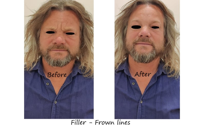 Before and after photos filler glabella – smoother glabella, youthful appearance without swelling