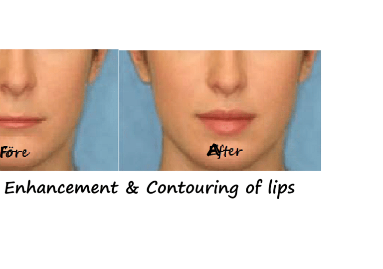 Before and after photos filler lips – increased volume, better contour and harmonious face.