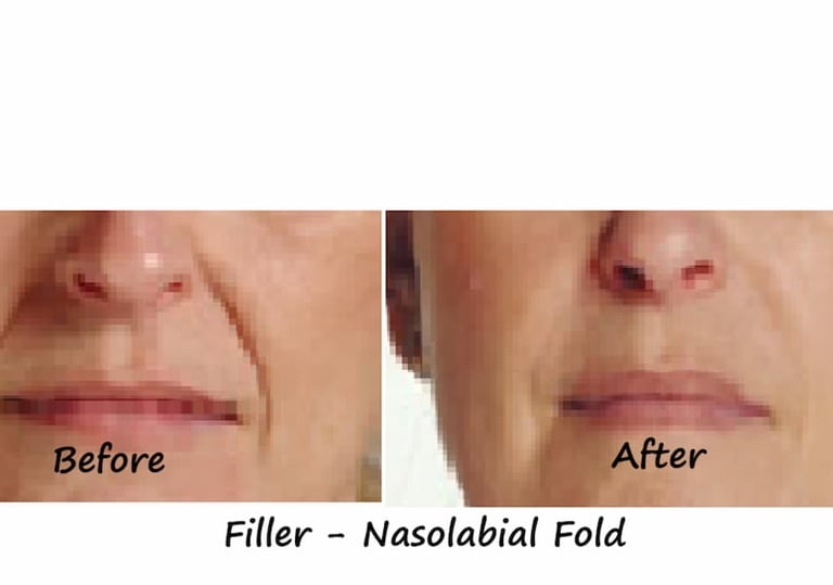 Before and after photos Filler nasolabial folds – smoother contour & younger appearance after filler