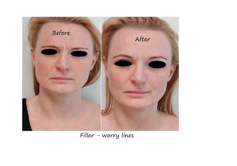 Before and after photos glabella filler – reduced wrinkles and smoother forehead.