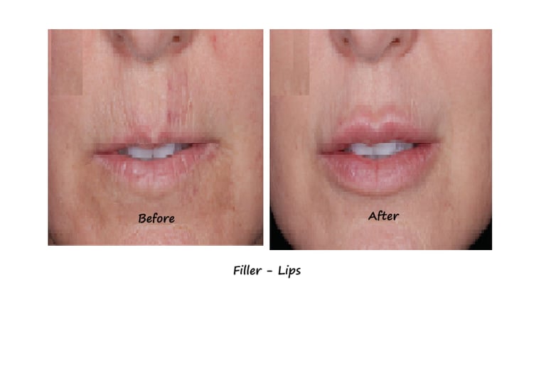 Before and after photos filler lips– more volume, fewer wrinkles around the mouth, natural shape