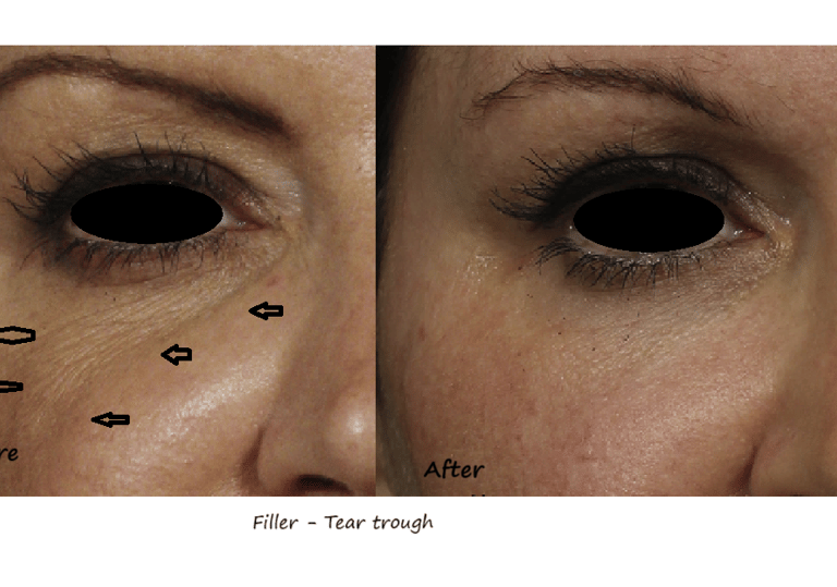 Before and after photos filler tear trough – reduced dark circles, smoother transition to cheeks.