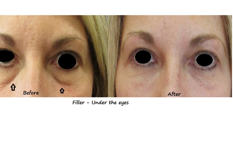 Before and after photos tear trough filler –restored volume and colour to under area.