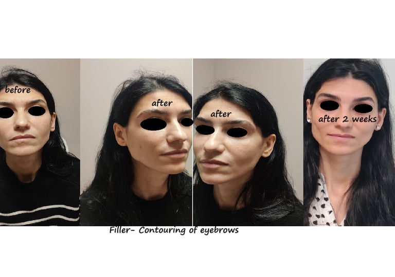 Before and after photos filler eyebrows contour – softer brows, lifted and harmonious face.