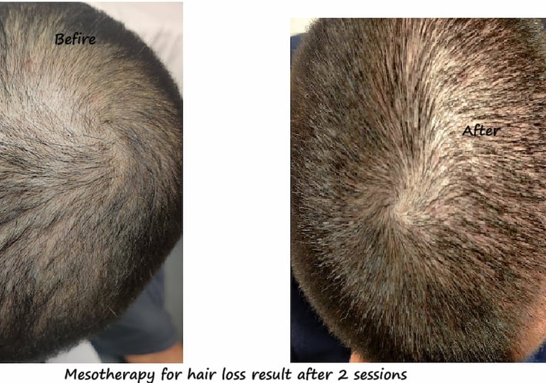 Before & after 1 session Mesotherapy Delhi – 42 yr male with hair loss, showing improved hair growth
